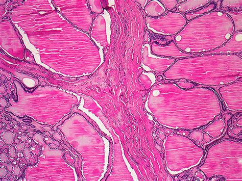 184a Colloid Goiter