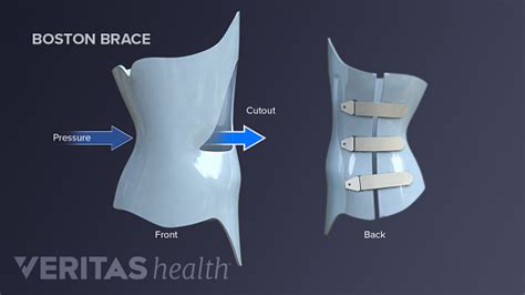 Types Of Scoliosis Braces