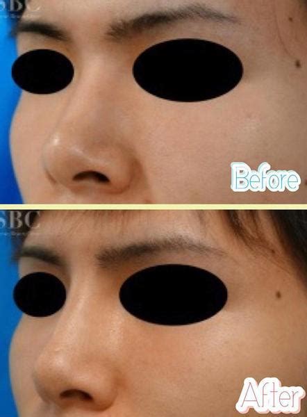 Best Asian Rhinoplasty Surgeon Before And After Rhinoplasty Cost Pics Reviews Q A