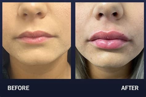 lip filler before and after pictures madnani facial plastic surgery