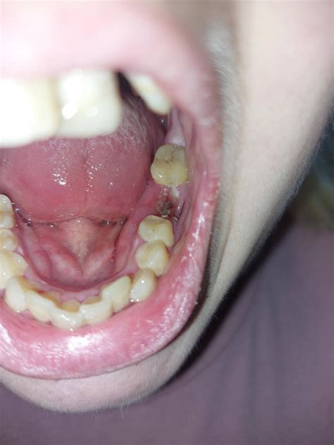 Potentially Infected Tooth Extraction Site Raskdentists