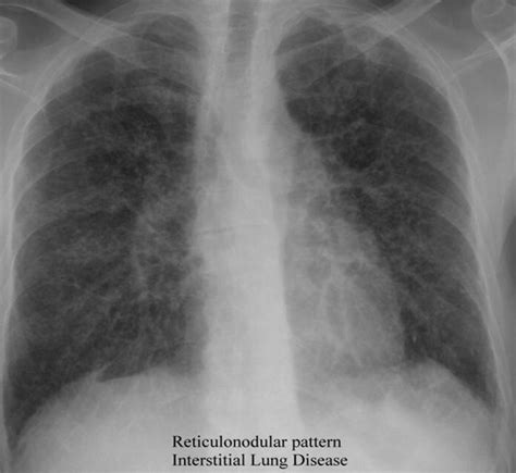 Maybe you would like to learn more about one of these? Lung Disease Adalah - Asthma Lung Disease