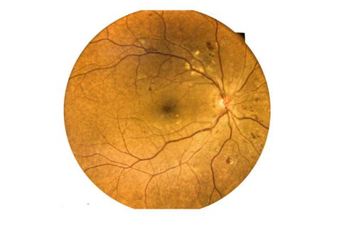Retinal Detachment Stock Photos Pictures And Royalty Free Images Istock