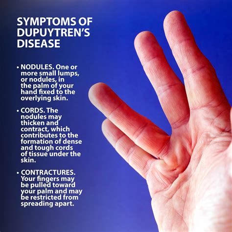 Dupuytrens Disease Info Florida Orthopaedic Institute