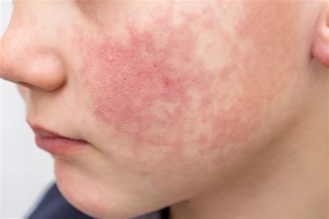 Red Cheeks On Children Could Be Sign Of Fifth Disease Simplemost