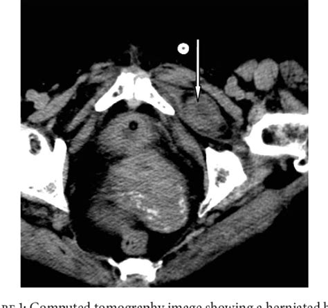 Figure 1 From Obturator Hernia A Rare Case Of Acute Mechanical