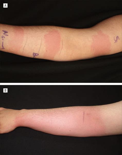 Aquagenic Urticaria And Syncope Associated With Occult Papillary