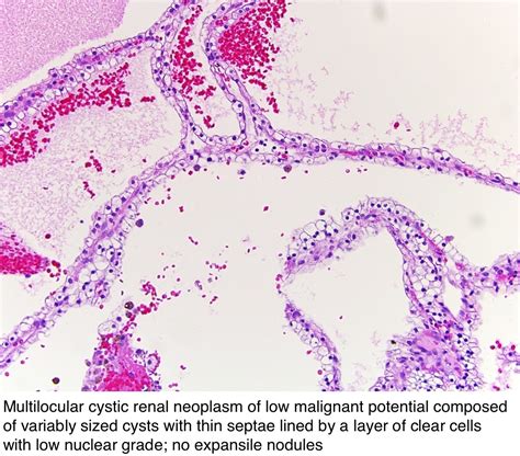 Pathology Outlines Multilocular Cystic Renal Neoplasm Of Low