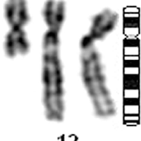 Arrow Demonstrates The Iso P Chromosome Detected By Fluorescence In
