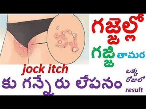 Dealing with jock itch is really mentally hard as well as an uncomfortable hassle, but taking quick action with if you have jock itch and looking for a cure, terrasil jock itch treatment is your answer. How to cure Jack itch in 1 day! గజ్జెల్లో గజ్జి తామర ను ...