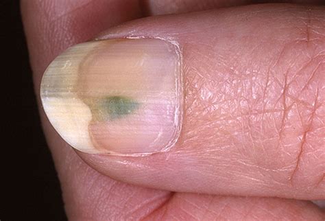 Are there any over the counter nail fungus. Sunny Health: What your nails say about you