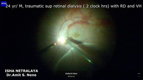 Traumatic Retinal Dialysis Rd With Vh Youtube