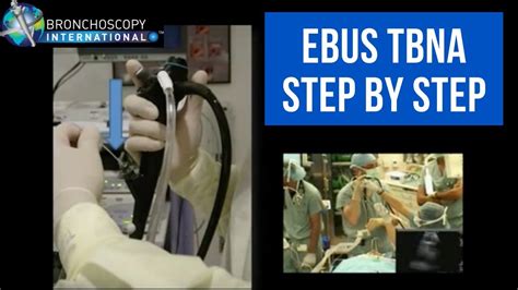 Ebus Bronchoscopy Endobronchial Ultrasound Step By Step Youtube