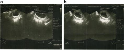 A Measurement Of Mean Sac Diameter At 8 Weeks Gestational Age Using