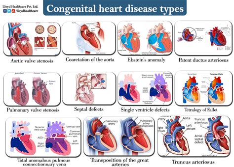 Congenital Heart Disease Pictures