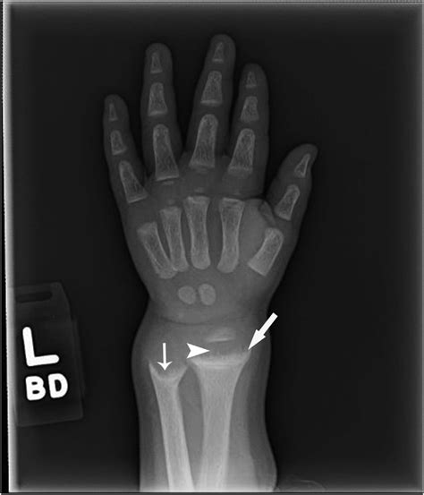 Frontal View Of The Left Wrist Obtained As Part Of A Rickets Bone