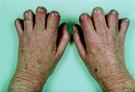 Treatment Of Cutaneous Calcinosis In Limited Systemic Sclerosis With