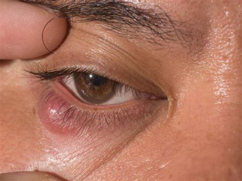 Top Causes Of Swollen Eyelids That You Need To Know About