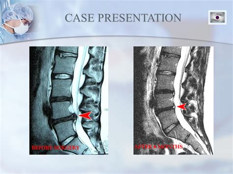 Dr Luis Lombardi L4l5 Herniated Disc Doctor Luis Lombardi