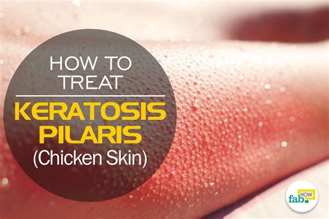 Get Rid Of Chicken Skin 5 Ways To Treat Keratosis Pilaris Keratosis