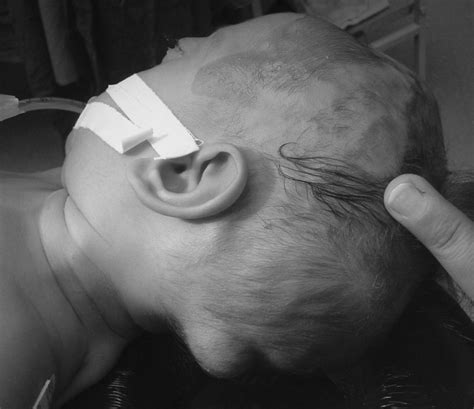 Acquired Craniomeningocele In An Infant With Craniosynostosis A Case