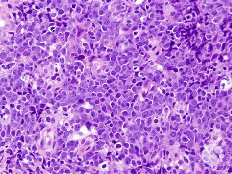 Large Diffuse B Cell Lymphoma