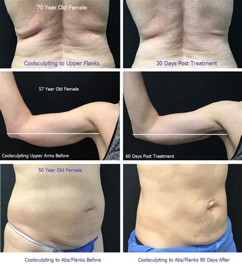 Ideal Image Coolsculpting Before And After