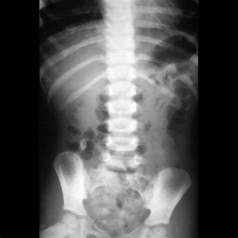 School Ager With Right Lower Quadrant Pain Pediatric Radiology Case