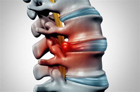 Herniated Disc Symptoms And Causes