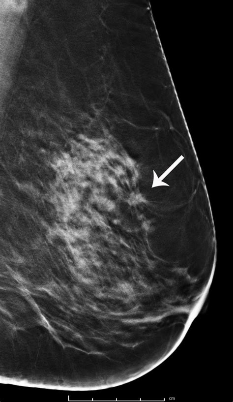 Breast Cancer Screening With 3d Mammography Or Tomosynthesis
