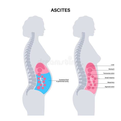 Ascites Disease Poster Stock Vector Illustration Of Abdomen 282695921