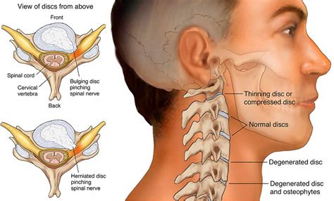 Cervical Radiculopathy Causes Symptoms Diagnosis And Treatment