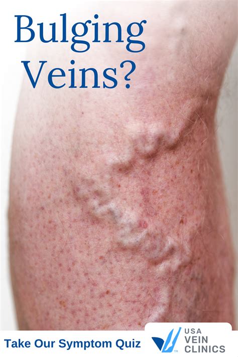 Bulging Veins Vein Clinic Bulging Veins Symptoms