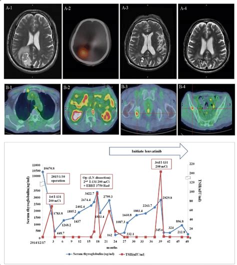 Upper Panel Dynamic Changes In Brain And Bone Metastases Hemorrhagic