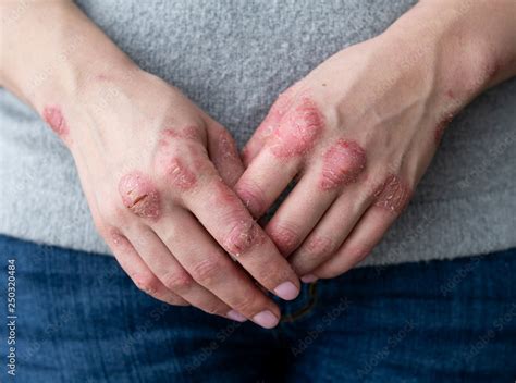 Fotografia Do Stock Cracked Flaky Skin On The Palm Of Your Hand