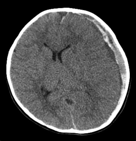 Computed Tomography At Arrival Reveals A Left Subdural Hematoma With A Download Scientific