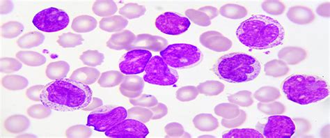The leukemia & lymphoma society® (lls) is a global leader in the fight against cancer. LEUCEMIA PROMIELOCITICA PDF