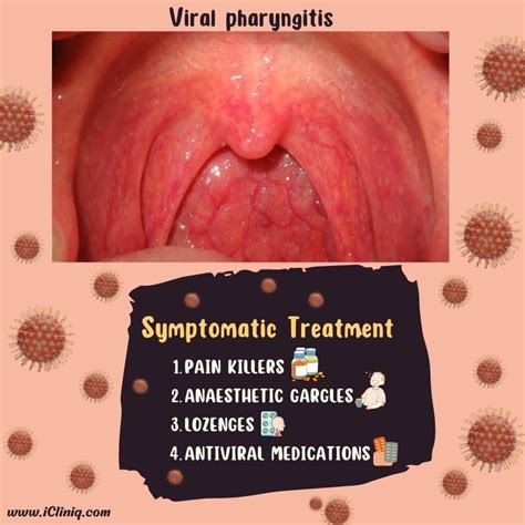 Viral Pharyngitis Causes Symptoms Diagnosis Treatment