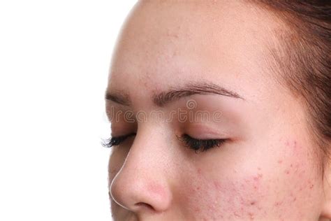 Teenage Girl With Acne Problem On White Background Stock Photo Image