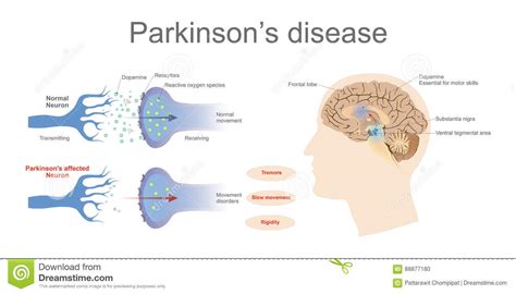In parkinson's disease, certain nerve cells (neurons) in the brain gradually break down or die. Masked Faces in Parkinson Disease - Fashion Digger