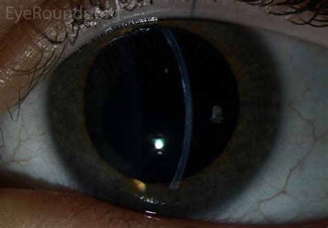 Posterior Polymorphous Corneal Dystrophy Ppmd