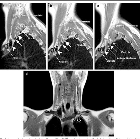 Mri Of Thoracic Outlet Syndrome In Children Semantic Scholar