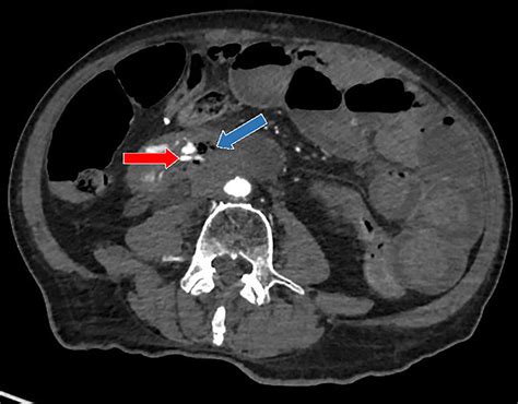 Selected Arterial Phase Axial Ct Image Showing Large Volume Active