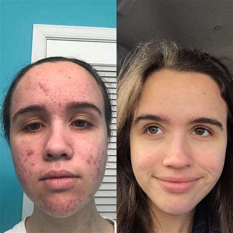 6 Months On Accutane Did This For Me Racne
