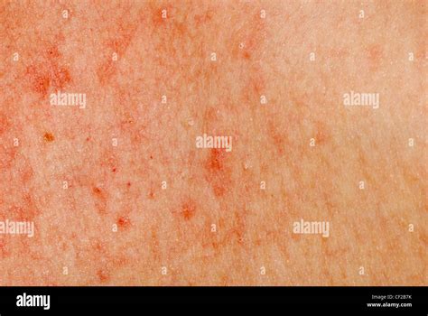 Eruzione Cutanea Allergica Dermatite La Texture Della Pelle Del Paziente Foto Stock Alamy