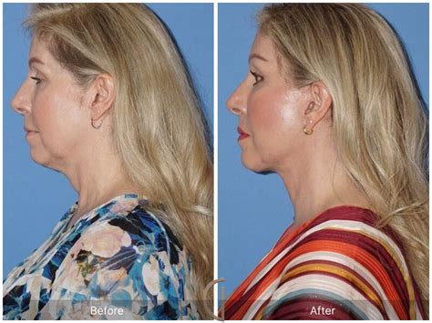 Facelift Fifties Before And After Photos Patient 79 Dr Kevin Sadati