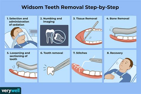 What To Expect When Getting Your Wisdom Teeth Removed 2023