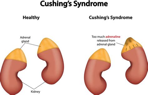 10 Symptoms Of Cushings Syndrome Cushings Syndrome High Cortisol