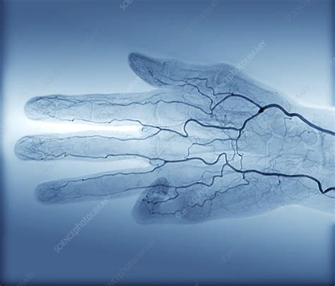 Blood Supply Of The Hand Angiogram Stock Image C0180386 Science