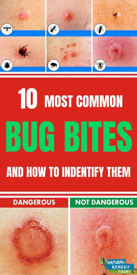 10 Most Common Bug Bites And How To Identify Them Bug Bites Bug